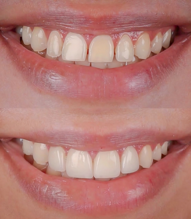 Orthodontic-treatment-before-&-after